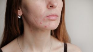 TIPS PARA CUIDAR TU CARA DEL USO DE CUBREBOCA